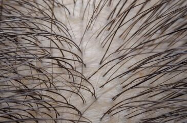 Hair Follicles
