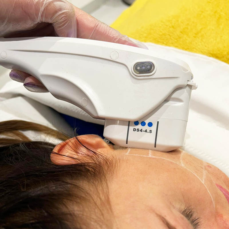 HIFU Facelift